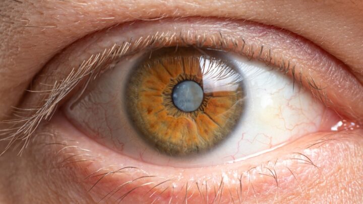 cataract-in-eye