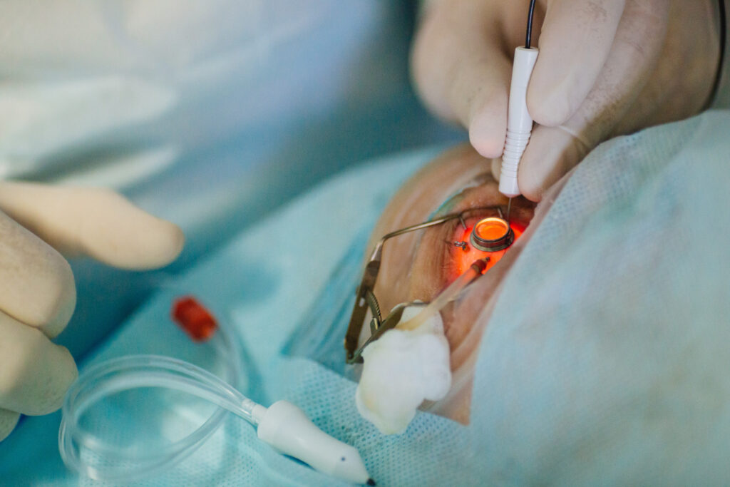 cataract eye surgery